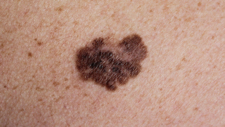 Indiqué en association chez l’adulte dans certains mélanomes ou CBNPC avec mutation BRAF.