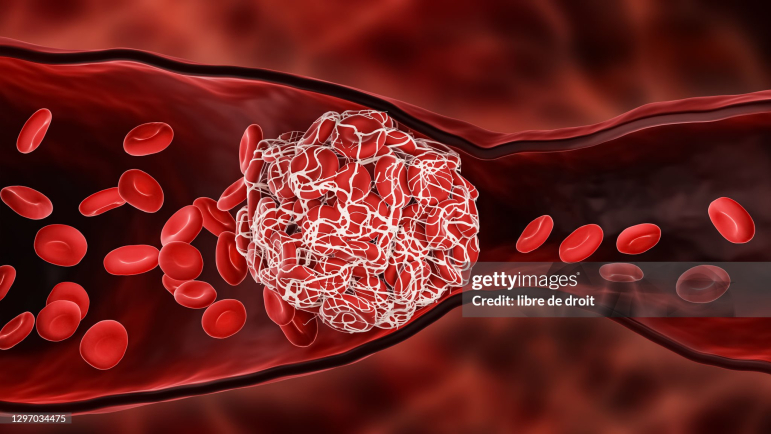 Les sujets déficitaires en FXI ne présentent généralement pas de saignements spontanés.