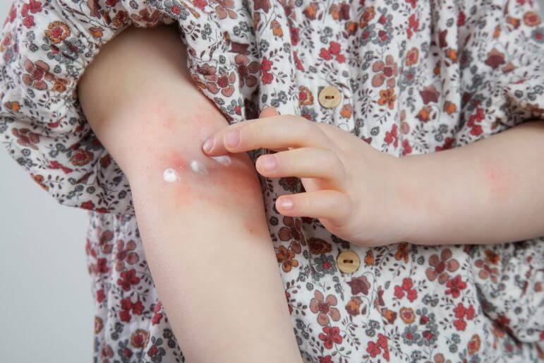 <p>La dermatite atopique est une dermatose inflammatoire chronique fréquente et multifactorielle.</p>
