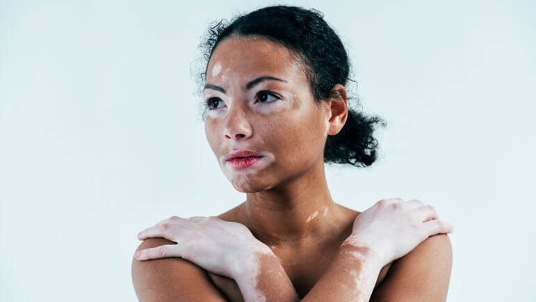 <p>Dans le vitiligo non segmentaire avec atteinte faciale.</p>