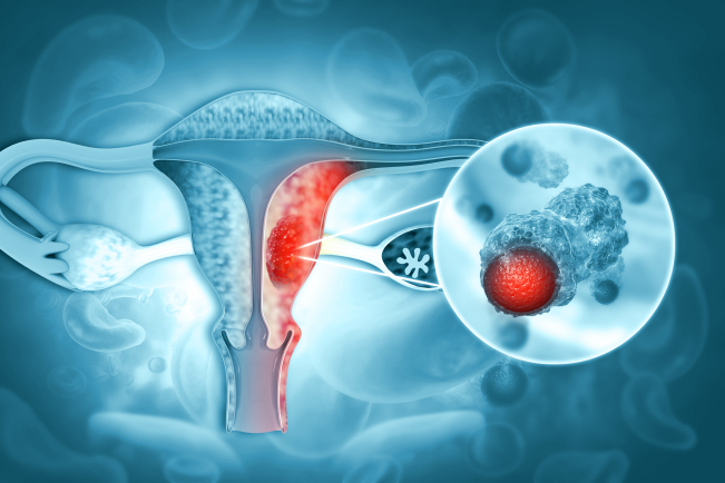 Le cancer de l'endomètre est la 4<sup>e</sup> cause de cancer chez la femme en France.