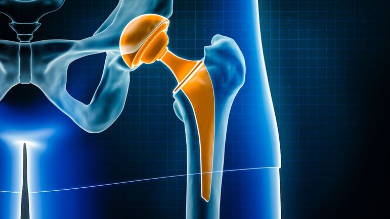 Le choix de la prothèse dépend de la santé, de l’âge et de l’anatomie de la hanche du patient.
