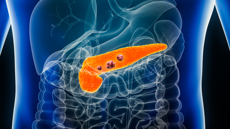 Le daraxonrasib, un inhibiteur de RAS, une protéine très souvent mutée dans le cancer du pancréas.