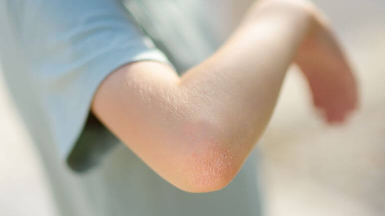 La prévalence du psoriasis en plaques de l’enfant est comprise entre 0,1 % à 1 an à 0,8 % à 18 ans.