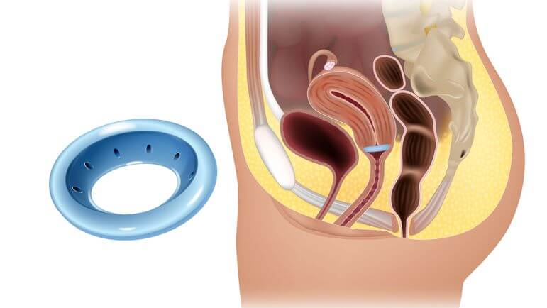 Le pessaire est un dispositif médical intravaginal invasif destiné à soutenir les organes pelviens.