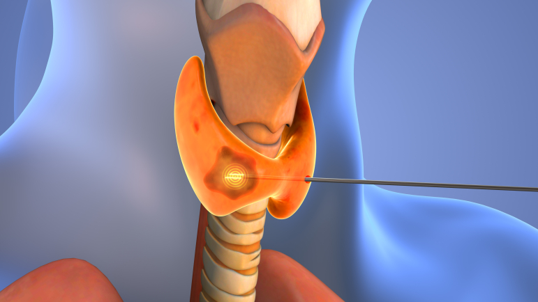 Éviter les surdiagnostics et les chirurgies inutiles sans passer à côté des nodules à risque. 
