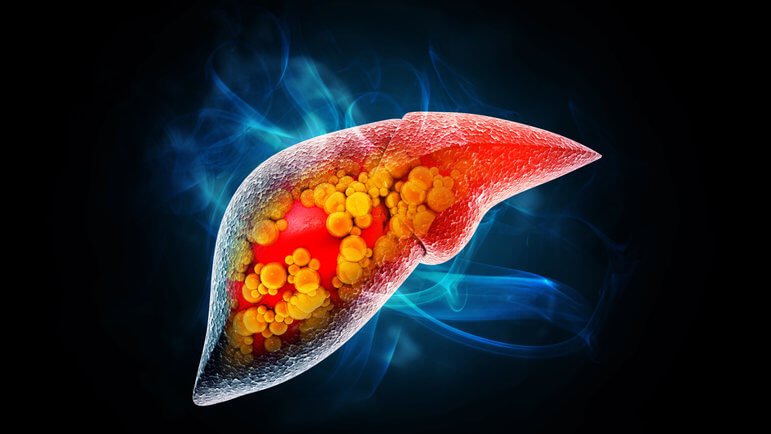 Les maladies dysmétaboliques du foie (MASLD) sont caractérisées par des hépatocytes stéatosiques.