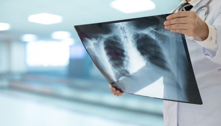 L’imagerie est à réaliser dans un délai court (moins de 72 h) sans retarder l'antibiothérapie.
