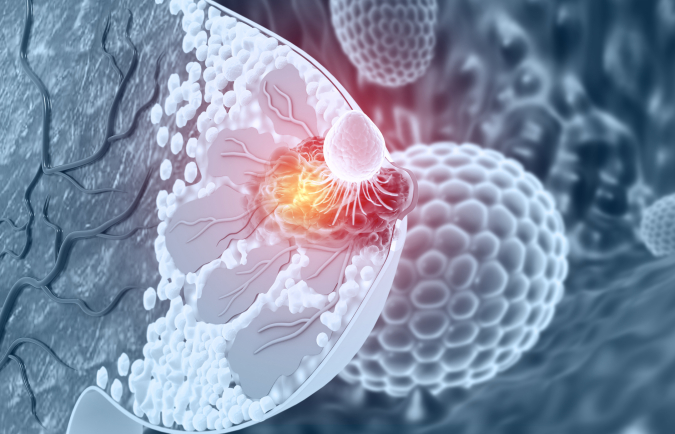 Kisqali est indiqué dans certains cancers du sein précoces, avancés ou métastatiques.