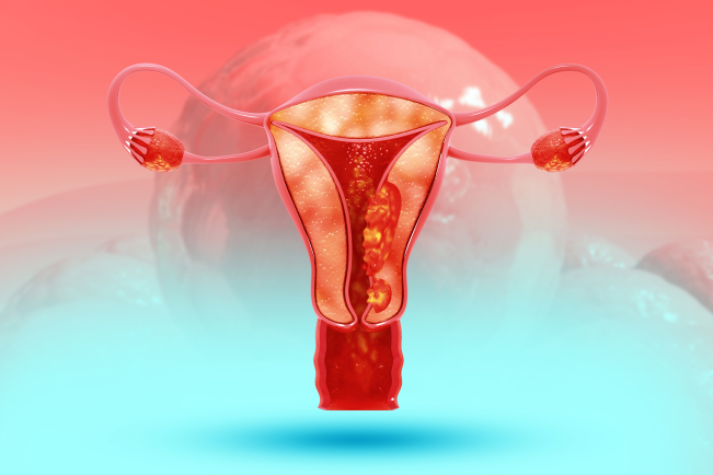 Le cancer de l’endomètre est au 4e rang des cancers chez la femme en France (GLOBOCA 2020).