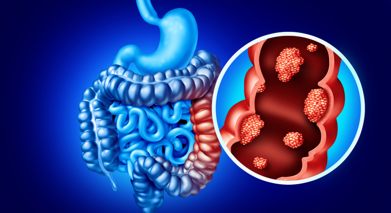 Le cancer colorectal est la 2<sup>e</sup> cause de mortalité par cancer après celui du poumon.