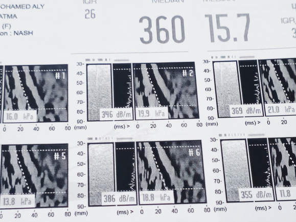 Le Fibroscan est l'un des tests non invasifs utilisés avec l'élasto-IRM pour mesurer la fibrose.