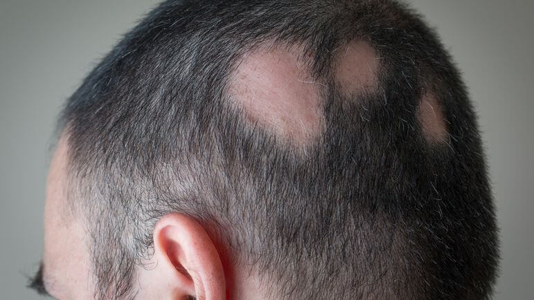 <p>La sévérité de la pelade est évaluée à l’aide du score de SALT (<em>Severity of Alopecia Tool</em>).</p>