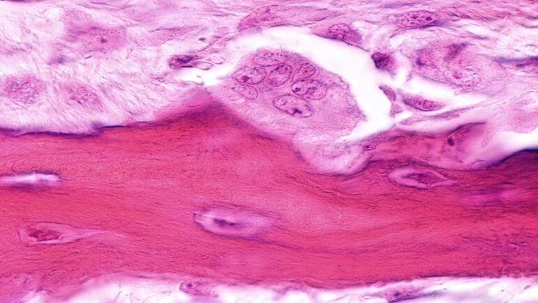 <p>Le dénosumab bloque l'activation du récepteur RANK situé sur les ostéoclastes et leurs précurseurs.</p>