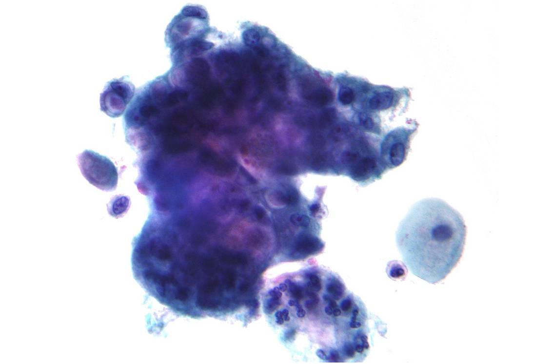 Etude au microscope d'un adénocarcinome révélant des vacuoles contenant de la mucine. Coloration de Papanicolaou (cliché @ Nephron, Wikimedia). 