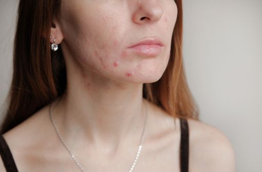 Survenant généralement à l’adolescence, l’acné est liée à l’hypersécrétion de sébum et à des anomalies de kératinisation aboutissant à la formation de comédons (illustration).