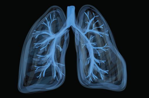 Le cancer bronchique non à petites cellules représente près de 85 % de l'ensemble des cancers du poumon (illustration).