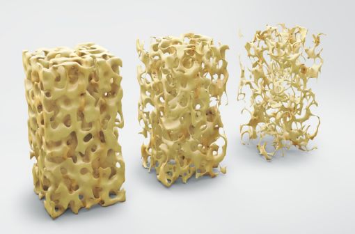 L'ostéoporose est caractérisée par une fragilité excessive du squelette, due à une diminution de la masse osseuse et à l'altération de la micro-architecture osseuse (illustration). 