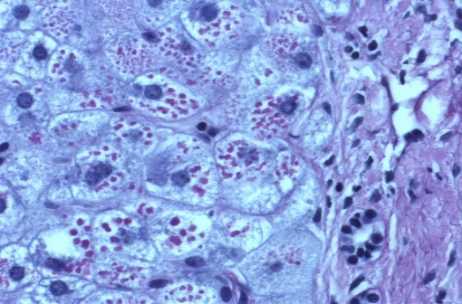 Technique de coloration au PAS : alpha-antitrypsine qui s’accumule dans les lysozomes des hépatocytes (illustration @Alexquaas sur Wikimedia).