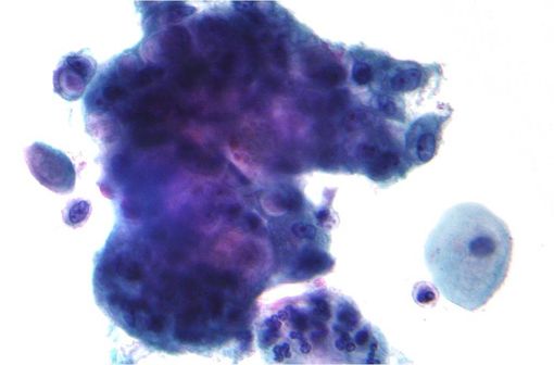 Etude au microscope d'un adénocarcinome révélant des vacuoles contenant de la mucine. Coloration de Papanicolaou (illustration @Nephron sur Wikimedia).
