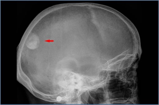 Radiographie du crâne montrant un méningiome (illustration @Hellerhoff sur Wikimedia).