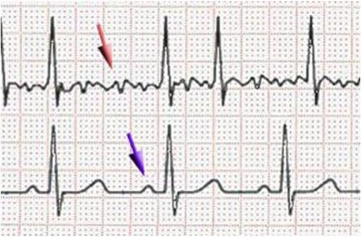 Fibrillation auriculaire : trémulations de la ligne iso-électrique (flèche rouge), ECG normal (rythme sinusal) : onde P (flèche violette) [illustration @J. Heuser sur Wikimédia).