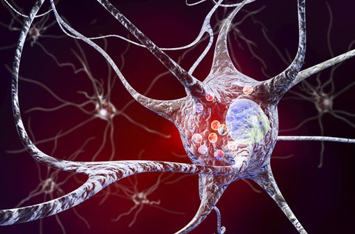 Dans la maladie de Parkinson, les corps de Lewy observés au niveau de la substance noire du cerveau correspondent à des amas pathogènes d'alfa-synucléine (illustration).