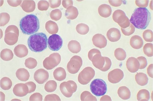 Lymphocytes B (cytoplasme bleu et noyau violet) lors d'une leucémie lymphoïde chronique observés sur sang périphérique (illustration @VashiDonsk, sur Wikimedia).