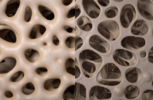 Os normal à gauche, os ostéoporotique à droite (modélisation 3D).