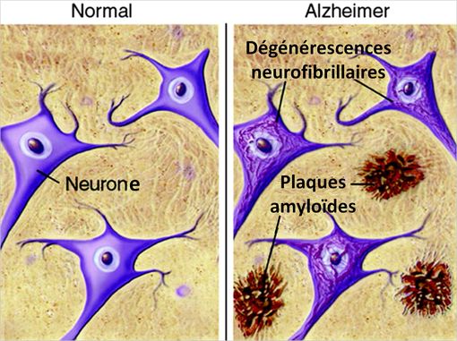 Les patients atteints d'une maladie d'Alzheimer présentent des lésions neuronales caractéristiques.