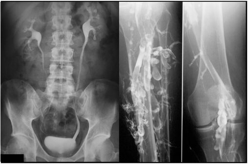 Urographie intraveineuse (à gauche) et phlébographie des membres inférieurs (à droite) [photos @ Glitzy queen00 et @ Hellerhoff, sur Wikimedia).