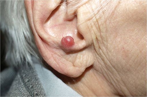 Carcinome à cellules de Merkel chez une patiente âgée de 94 ans (illustration @Klaus D. Peter,  sur Wikimédia). width=