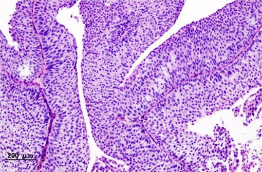 Carcinome urothélial de la vessie de stade pT1 (cliché @ Wikimedia).