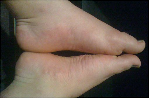 Comparaison entre un pied atteind de goutte et son symétrique, mettant en évidence le gonflement des tissus environnants (illustration @Fatlittlebastard sur Wikimedia).