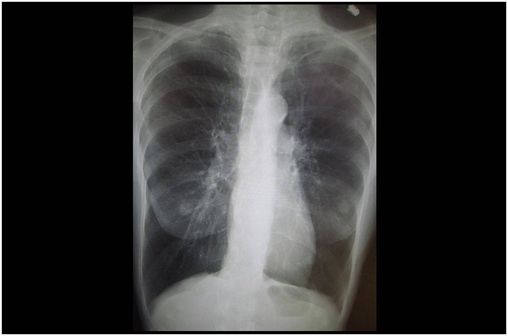 Radiographie pulmonaire montrant une BPCO sévère. A noter, la petite taille du cœur par rapport au thorax (photo @ Dr James Heilman sur Wikimedia).