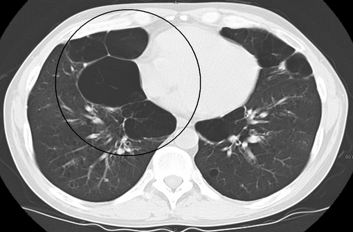 Cliché de tomodensitométrie montrant des lésions emphysémateuses dans le poumon droit (illustration @James Heilman, MD, sur Wikimedia).