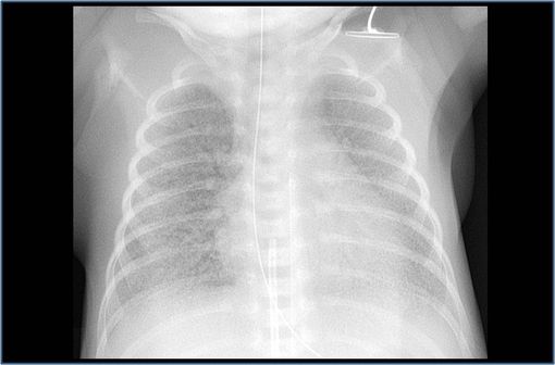 Radiographie thoracique d'un nouveau-né ayant développé un syndrome de détresse respiratoire (illustration @Mikael Häggström sur Wikimedia).