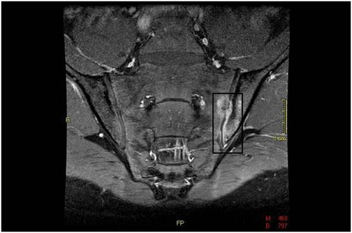 Sacro-iliite chez un patient atteint de spondylarthrite ankylosante / IRM au gadolinium (illustration @Lange123 sur Wikimedia).