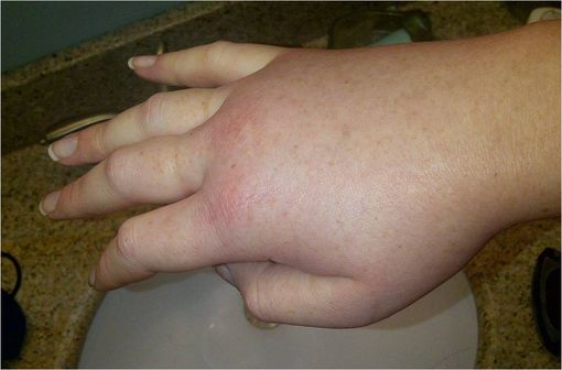 Main droite œdèmatiée lors d'un accès d’angio-œdème héréditaire (illustration @LucyHAE sur Wikimedia). 