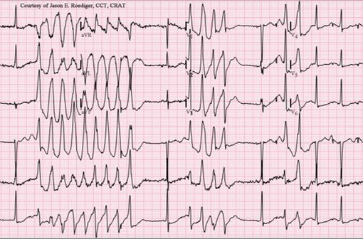 Le syndrome du QT long expose les patients qui en sont atteints à un risque significatif de torsades de pointes ou de fibrillation ventriculaire (illustration @Jer5150 sur Wikimedia).