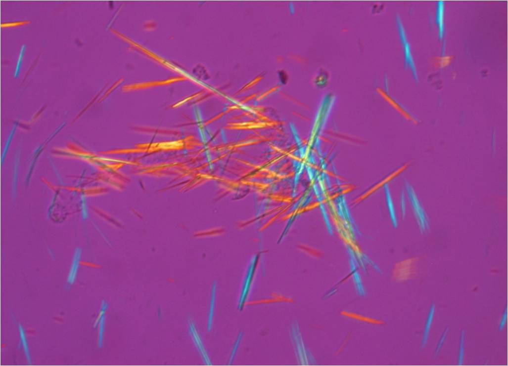 Cristaux d'acide urique dans du liquide synovial, visualisés au microscope en lumière polarisée (illustration @Bobjgalindo, sur Wikimedia).