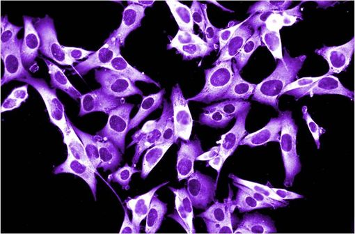 Le mélanome est un cancer de la peau ou des muqueuses, développé aux dépens des mélanocytes (illustration).
