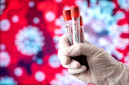 Indications des tests sérologiques COVID19 : la HAS actualise ses  recommandations