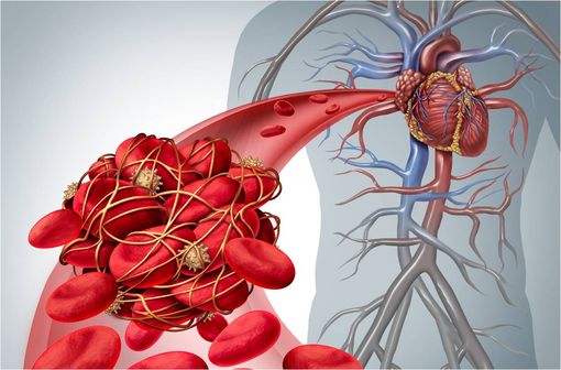 Les héparines de bas poids moléculaire (HBPM), telle l’énoxaparine, occupent une place primordiale dans la prise en charge de la maladie thrombo-embolique veineuse et du syndrome coronaire aigu (illustration).