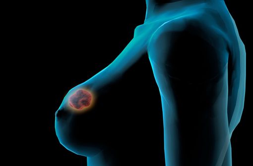CARDIOXANE est indiqué chez les adultes pour la prévention de la cardiotoxicité chronique cumulative causée par l'administration d'anthracycline chez des patients atteints d'un cancer du sein avancé et/ou métastatique (illustration).