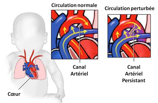 PEDEA est indiqué dans le traitement du canal artériel persistant (adaptation d'une illustration provenant du blog http://odlarmed.com)