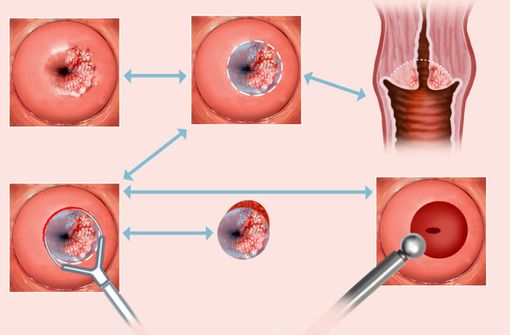 Cancer du col de l'utérus (illustration). 