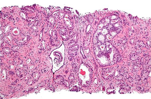 Cancer de la prostate, aspect microscopique score de Gleason 4 (cliché @ Nephron sur Wikimedia).