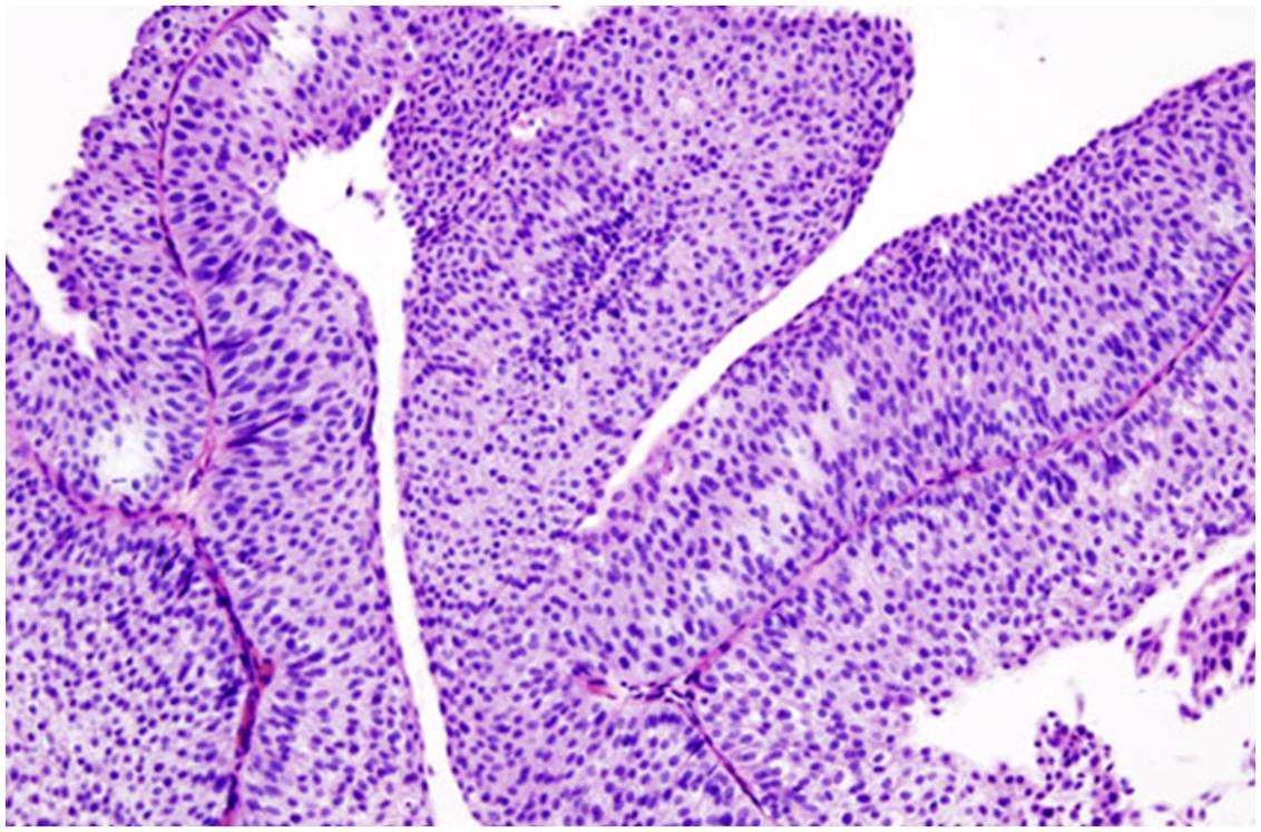 Image histopathologique d'un carcinome urothélial de la vessie de stade pT1. Biopsie transurétrale (cliché @ Wikimedia).