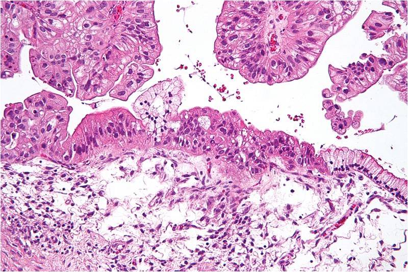 Coupe histologique d'un cancer de l'ovaire (@ Nephron, Wikimedia)